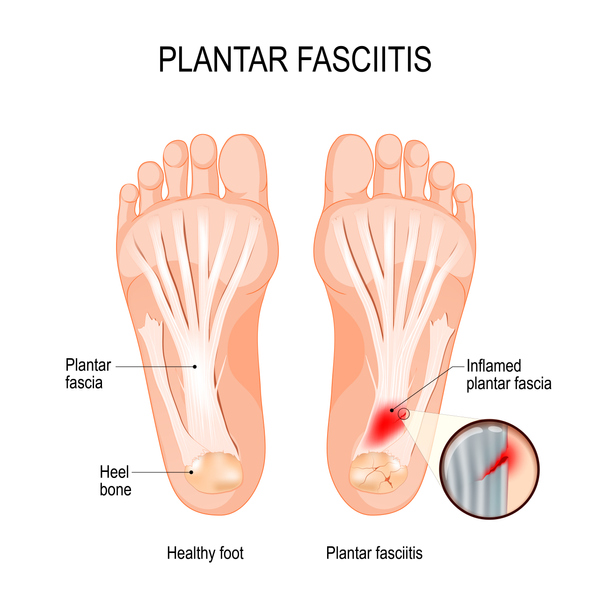 Plantar fasciitis. disorder of the connective tissue which supports the arch of the foot Plantar Fasciitis